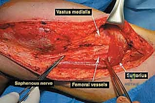 مقارنة بين البتر وإنقاذ الطرف