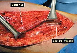 قياسات الطرف الاصطناعي