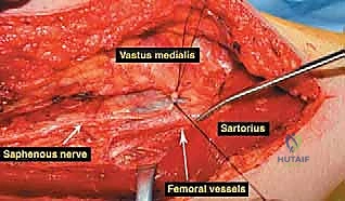 التخطيط الجراحي لإنقاذ الطرف