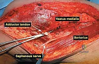 الشق الجراحي والوصول للعظم