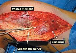 أشعة مقطعية للورم