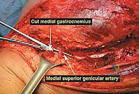 تغطية الطرف الاصطناعي