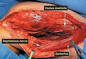 العلاج الطبيعي بعد الجراحة