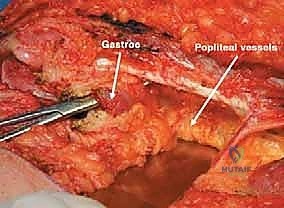 إغلاق الجرح التجميلي