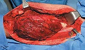 صورة طبية: إعادة بناء عظم الفخذ البعيد بالطرف الاصطناعي: أمل جديد لمرضى أورام العظام في صنعاء مع الأستاذ الدكتور محمد هطيف