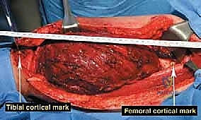 صورة طبية: إعادة بناء عظم الفخذ البعيد بالطرف الاصطناعي: أمل جديد لمرضى أورام العظام في صنعاء مع الأستاذ الدكتور محمد هطيف