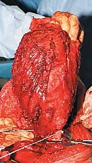 صورة طبية: إعادة بناء عظم الفخذ البعيد بالطرف الاصطناعي: أمل جديد لمرضى أورام العظام في صنعاء مع الأستاذ الدكتور محمد هطيف