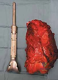 صورة طبية: إعادة بناء عظم الفخذ البعيد بالطرف الاصطناعي: أمل جديد لمرضى أورام العظام في صنعاء مع الأستاذ الدكتور محمد هطيف