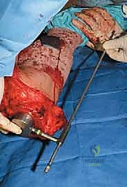 صورة طبية: إعادة بناء عظم الفخذ البعيد بالطرف الاصطناعي: أمل جديد لمرضى أورام العظام في صنعاء مع الأستاذ الدكتور محمد هطيف