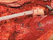 صورة طبية: إعادة بناء عظم الفخذ البعيد بالطرف الاصطناعي: أمل جديد لمرضى أورام العظام في صنعاء مع الأستاذ الدكتور محمد هطيف