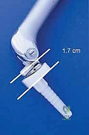 صورة طبية: إعادة بناء عظم الفخذ البعيد بالطرف الاصطناعي: أمل جديد لمرضى أورام العظام في صنعاء مع الأستاذ الدكتور محمد هطيف