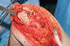 صورة طبية: إعادة بناء عظم الفخذ البعيد بالطرف الاصطناعي: أمل جديد لمرضى أورام العظام في صنعاء مع الأستاذ الدكتور محمد هطيف