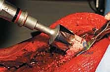 صورة طبية: إعادة بناء عظم الفخذ البعيد بالطرف الاصطناعي: أمل جديد لمرضى أورام العظام في صنعاء مع الأستاذ الدكتور محمد هطيف