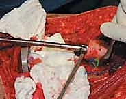 صورة توضيحية لـ إعادة بناء عظم الفخذ البعيد بالطرف الاصطناعي: أمل جديد لمرضى أورام العظام في صنعاء مع الأستاذ الدكتور محمد هطيف