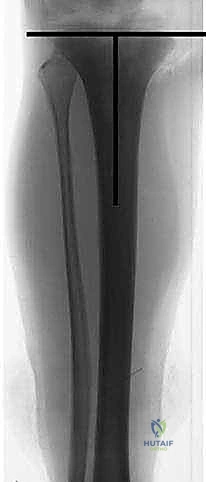 صورة طبية: إعادة بناء عظم الفخذ البعيد بالطرف الاصطناعي: أمل جديد لمرضى أورام العظام في صنعاء مع الأستاذ الدكتور محمد هطيف