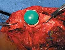 صورة توضيحية لـ إعادة بناء عظم الفخذ البعيد بالطرف الاصطناعي: أمل جديد لمرضى أورام العظام في صنعاء مع الأستاذ الدكتور محمد هطيف