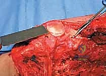 صورة طبية: إعادة بناء عظم الفخذ البعيد بالطرف الاصطناعي: أمل جديد لمرضى أورام العظام في صنعاء مع الأستاذ الدكتور محمد هطيف