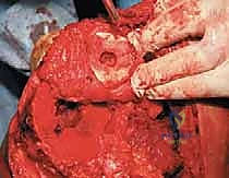 صورة طبية: إعادة بناء عظم الفخذ البعيد بالطرف الاصطناعي: أمل جديد لمرضى أورام العظام في صنعاء مع الأستاذ الدكتور محمد هطيف