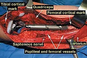 إعادة بناء عظم الفخذ البعيد بالطرف الاصطناعي: أمل جديد لمرضى أورام العظام في صنعاء مع الأستاذ الدكتور محمد هطيف