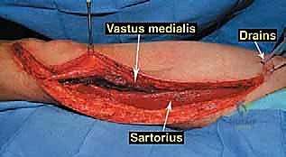 صورة طبية: إعادة بناء عظم الفخذ البعيد بالطرف الاصطناعي: أمل جديد لمرضى أورام العظام في صنعاء مع الأستاذ الدكتور محمد هطيف