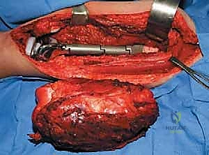 صورة طبية: إعادة بناء عظم الفخذ البعيد بالطرف الاصطناعي: أمل جديد لمرضى أورام العظام في صنعاء مع الأستاذ الدكتور محمد هطيف