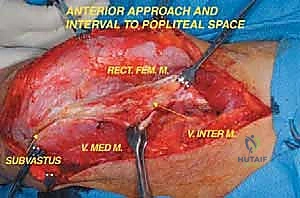 صورة طبية: إعادة بناء عظم الفخذ البعيد بالطرف الاصطناعي: أمل جديد لمرضى أورام العظام في صنعاء مع الأستاذ الدكتور محمد هطيف