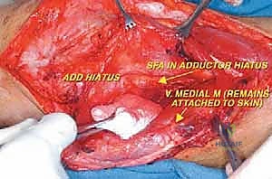 صورة طبية: إعادة بناء عظم الفخذ البعيد بالطرف الاصطناعي: أمل جديد لمرضى أورام العظام في صنعاء مع الأستاذ الدكتور محمد هطيف