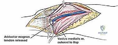 صورة طبية: إعادة بناء عظم الفخذ البعيد بالطرف الاصطناعي: أمل جديد لمرضى أورام العظام في صنعاء مع الأستاذ الدكتور محمد هطيف