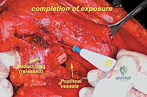 صورة طبية: إعادة بناء عظم الفخذ البعيد بالطرف الاصطناعي: أمل جديد لمرضى أورام العظام في صنعاء مع الأستاذ الدكتور محمد هطيف