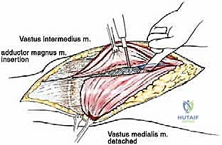 صورة طبية: إعادة بناء عظم الفخذ البعيد بالطرف الاصطناعي: أمل جديد لمرضى أورام العظام في صنعاء مع الأستاذ الدكتور محمد هطيف