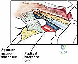 صورة طبية: إعادة بناء عظم الفخذ البعيد بالطرف الاصطناعي: أمل جديد لمرضى أورام العظام في صنعاء مع الأستاذ الدكتور محمد هطيف