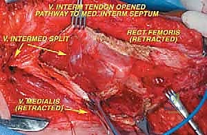 صورة طبية: إعادة بناء عظم الفخذ البعيد بالطرف الاصطناعي: أمل جديد لمرضى أورام العظام في صنعاء مع الأستاذ الدكتور محمد هطيف