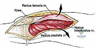 صورة توضيحية لـ إعادة بناء عظم الفخذ البعيد بالطرف الاصطناعي: أمل جديد لمرضى أورام العظام في صنعاء مع الأستاذ الدكتور محمد هطيف