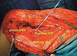 صورة طبية: إعادة بناء عظم الفخذ البعيد بالطرف الاصطناعي: أمل جديد لمرضى أورام العظام في صنعاء مع الأستاذ الدكتور محمد هطيف