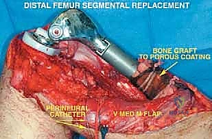 صورة طبية: إعادة بناء عظم الفخذ البعيد بالطرف الاصطناعي: أمل جديد لمرضى أورام العظام في صنعاء مع الأستاذ الدكتور محمد هطيف