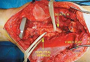 صورة طبية: إعادة بناء عظم الفخذ البعيد بالطرف الاصطناعي: أمل جديد لمرضى أورام العظام في صنعاء مع الأستاذ الدكتور محمد هطيف