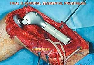 تشريح عظم الفخذ والأورام