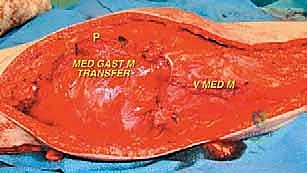 صورة طبية: إعادة بناء عظم الفخذ البعيد بالطرف الاصطناعي: أمل جديد لمرضى أورام العظام في صنعاء مع الأستاذ الدكتور محمد هطيف