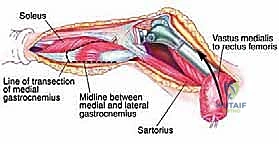 صورة طبية: إعادة بناء عظم الفخذ البعيد بالطرف الاصطناعي: أمل جديد لمرضى أورام العظام في صنعاء مع الأستاذ الدكتور محمد هطيف