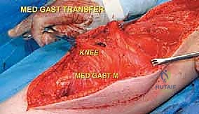 صورة طبية: إعادة بناء عظم الفخذ البعيد بالطرف الاصطناعي: أمل جديد لمرضى أورام العظام في صنعاء مع الأستاذ الدكتور محمد هطيف