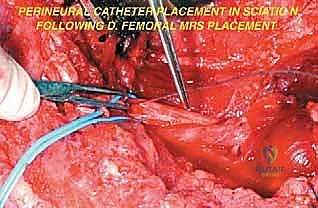 صورة طبية: إعادة بناء عظم الفخذ البعيد بالطرف الاصطناعي: أمل جديد لمرضى أورام العظام في صنعاء مع الأستاذ الدكتور محمد هطيف