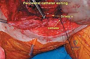 صورة توضيحية لـ إعادة بناء عظم الفخذ البعيد بالطرف الاصطناعي: أمل جديد لمرضى أورام العظام في صنعاء مع الأستاذ الدكتور محمد هطيف