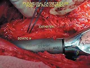 صورة طبية: إعادة بناء عظم الفخذ البعيد بالطرف الاصطناعي: أمل جديد لمرضى أورام العظام في صنعاء مع الأستاذ الدكتور محمد هطيف