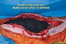 صورة طبية: إعادة بناء عظم الفخذ البعيد بالطرف الاصطناعي: أمل جديد لمرضى أورام العظام في صنعاء مع الأستاذ الدكتور محمد هطيف