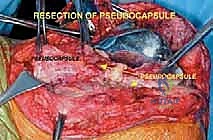 صورة طبية: إعادة بناء عظم الفخذ البعيد بالطرف الاصطناعي: أمل جديد لمرضى أورام العظام في صنعاء مع الأستاذ الدكتور محمد هطيف