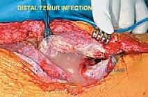 صورة توضيحية لـ إعادة بناء عظم الفخذ البعيد بالطرف الاصطناعي: أمل جديد لمرضى أورام العظام في صنعاء مع الأستاذ الدكتور محمد هطيف