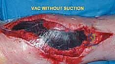 صورة طبية: إعادة بناء عظم الفخذ البعيد بالطرف الاصطناعي: أمل جديد لمرضى أورام العظام في صنعاء مع الأستاذ الدكتور محمد هطيف