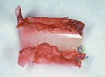 صورة طبية: إعادة بناء عظم الفخذ البعيد بالطرف الاصطناعي: أمل جديد لمرضى أورام العظام في صنعاء مع الأستاذ الدكتور محمد هطيف