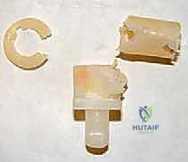 صورة طبية: إعادة بناء عظم الفخذ البعيد بالطرف الاصطناعي: أمل جديد لمرضى أورام العظام في صنعاء مع الأستاذ الدكتور محمد هطيف