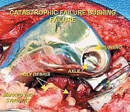 صورة طبية: إعادة بناء عظم الفخذ البعيد بالطرف الاصطناعي: أمل جديد لمرضى أورام العظام في صنعاء مع الأستاذ الدكتور محمد هطيف